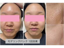 ミイン 宮代(MIIN)の雰囲気（肌質改善☆毛穴吸引やモデリングパックで美白へと導きます！）