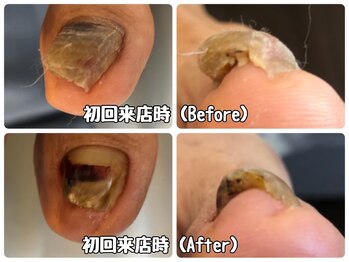 モアニヒロオ 広尾駅前店(MOANI Hiroo)/肥厚爪のお掃除