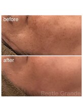 ビューティーモール(BEAUTY MALL)/パワーライトフェイシャル1回