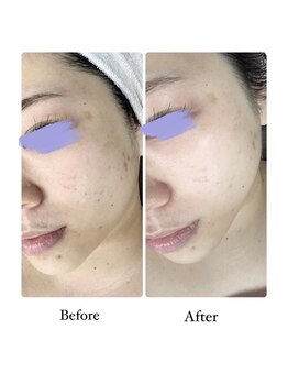 ヴィノ アイサロン(VINNO eyesalon)/ハーブピーリング☆