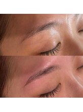 ブリリア(Brillia)/輪郭スッキリ施術例