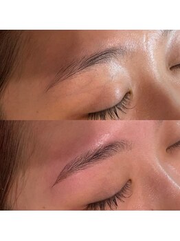 ブリリア(Brillia)/輪郭スッキリ施術例