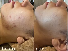 グレイティア(gratia)/その時の肌悩みで施術を提案！