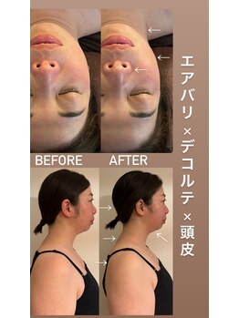 アンミー(anmiiy)/40代エアバリ変化/首肩頭