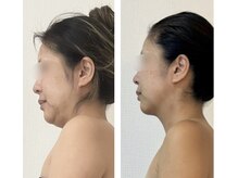 米香(MAIKA)の雰囲気(【二重顎×巻肩】根本改善で360度どこから見ても爆美小顔に◎)