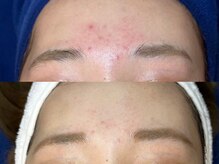 ロイ 初生店(LOI)/ハーブ×プラズマ