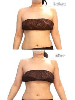 リリィブラン(Lily branc)/ブライダル痩身/上半身痩身