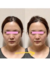 アレイズ/小顔矯正コース