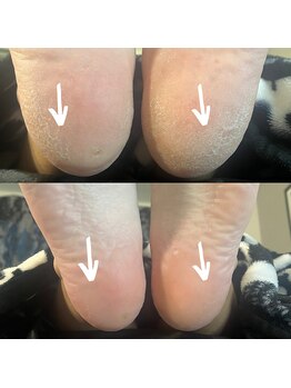 トウキョウビューティーラボ 表参道店(TOKYO BEAUTY LABO.)/韓国式★足裏角質ケア