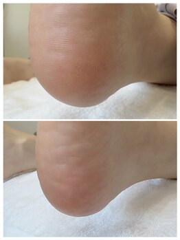 リンネ(Rinne)/角質ケア