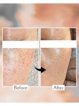 バイオ スキン プラス(Bio Skin Plus)/レモンボトル×プラピール