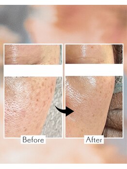 バイオ スキン プラス(Bio Skin Plus)/レモンボトル×プラピール