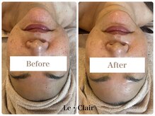 スキンセラピーサロン ル クレール(Le Clair)/Before→After
