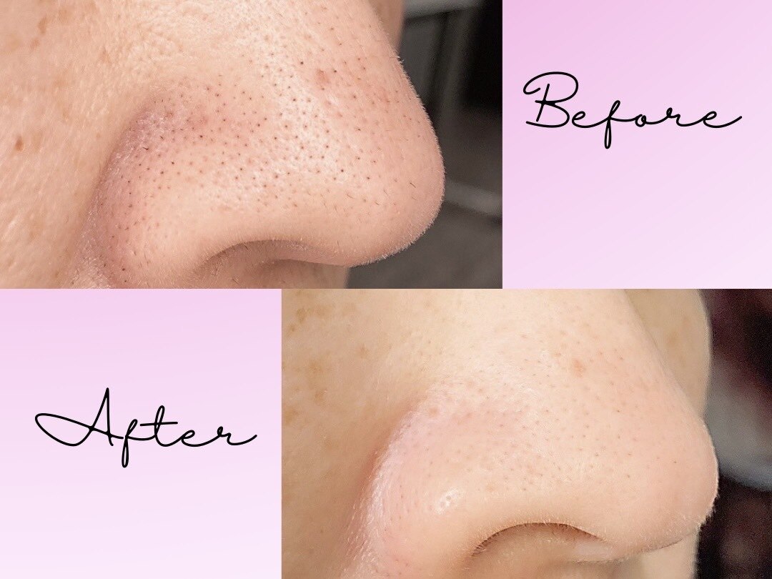 福津市で毛穴洗浄・毛穴吸引が人気のエステサロン｜ホットペッパー