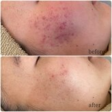 セラピー(therapy)