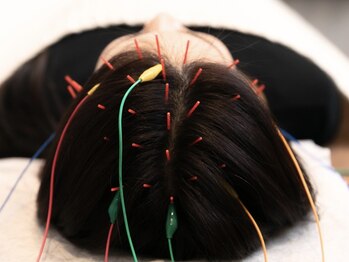 あたまの再起動/【あたまの鍼×電気】