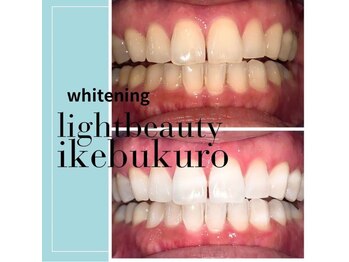 ライトビューティー 池袋店(LightBeauty)/症例写真