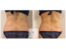 レミュ(Remu)/脂肪燃焼液10ml