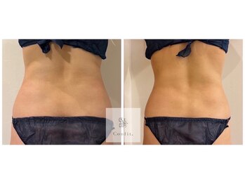 レミュ(Remu)/脂肪燃焼液10ml