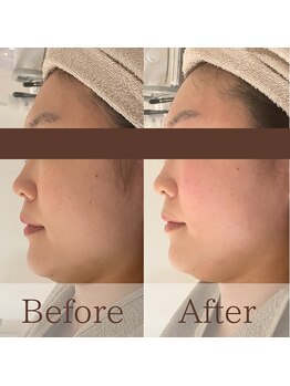 凪眠/小顔リンパフェイシャルの効果63