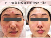 クリニカルエステ/イーズ 六甲アイランド店の雰囲気(満足度No.1☆【ヒト臍帯血幹細胞胞培養液導入コース】¥9900体験)