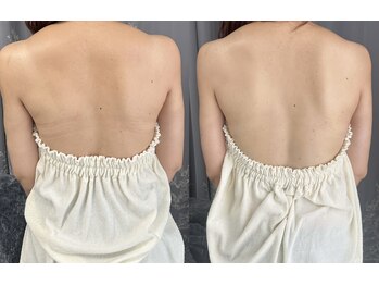 ムーンサン(Moon sun)の写真/ハーブピーリングは実は身体にも効果的◎自分では見えない背中こそ、プロにお任せ♪肩甲骨もくっきり!