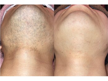 アネモネ ビューティーズ サロン(Anemone Beauty's salon)/ひげ脱毛 Before→After