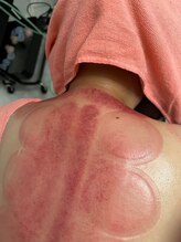 ミカ ネスト(Mika Nest)/スライドカッピング