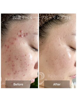 ブールドネージュ(Boule de Neige)/肌質改善リベルハーブピーリング