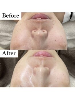 ウルル(ULuLu)/ビフォーアフター