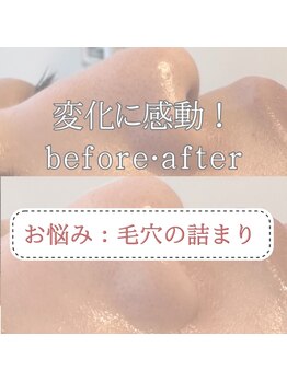 天使の艶肌/お悩み「毛穴の詰まり」