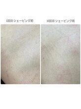 美肌脱毛専門店 パールプラス 大在店/全身脱毛