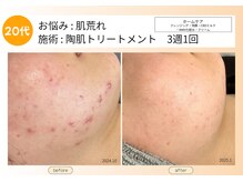 ムーンサン(Moon sun)/20代、陶肌ケアで本格肌質改善