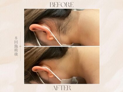 美肌脱毛【Tulipe sakae】顔脱毛/うなじ脱毛/脇脱毛/VIO脱毛/脱毛/毛穴ケア/毛穴洗浄の写真