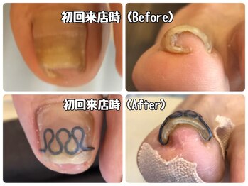 モアニヒロオ 広尾駅前店(MOANI Hiroo)/巻き爪矯正☆