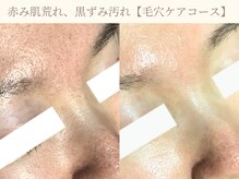 エミルカ 仙台(EMILUCA)の雰囲気（長年苦しんだ毛穴悩みから解放！全顔ケアでつるんと毛穴美人に◎）