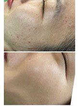 ナチュライズ(NatuRise)/ニキビケア、毛穴、肌質改善