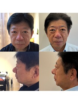 ホロニック ベルサンテ(Holonic Belle Sante)/小顔/リフトアップ