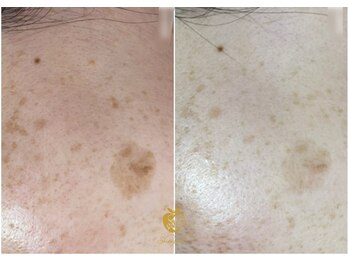 しらゆき 名古屋黒川/シミケア