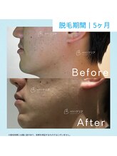 メンズクリア 松戸店/【メンズクリア】お客様の施術例