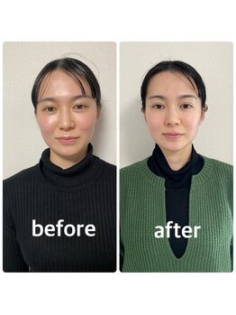 グッドライフペイ(Good Life Pay)/小顔フェイシャルの効果(1回目)