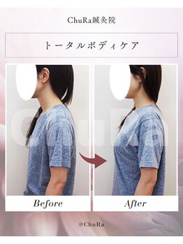 チュラ鍼灸院 西宮北口(ChuRa鍼灸院)/姿勢矯正