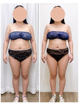 ミロク(369)/脂肪冷却痩身