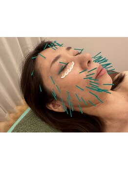 鍼灸施術を受けたい