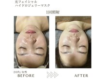 サロン エイトミー(salon 83)/光フェイシャル+ジェリーマスク