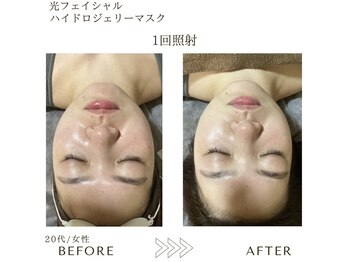 サロン エイトミー(salon 83)/光フェイシャル+ジェリーマスク