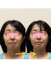 アレイズ/小顔矯正コース