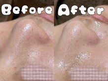 グラシア 倉敷店(Gracia)/ハイドラ毛穴洗浄