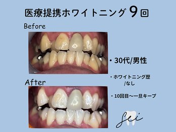 セイ(sei)/ホワイトニングビフォーアフター