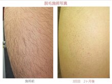 ロイ 梅田茶屋町店(LoY)/あし脱毛